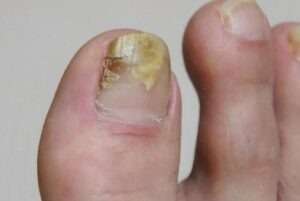 爪や皮膚の色が変わるのは巻き爪が原因？知っておきたい変色と爪の関係！