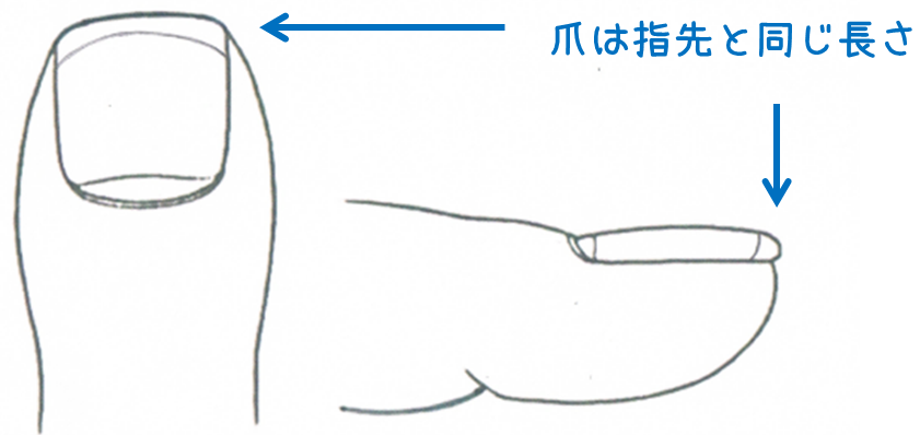 【巻き爪　再発予防　爪切り】正しい爪切りで巻き爪再発予防！